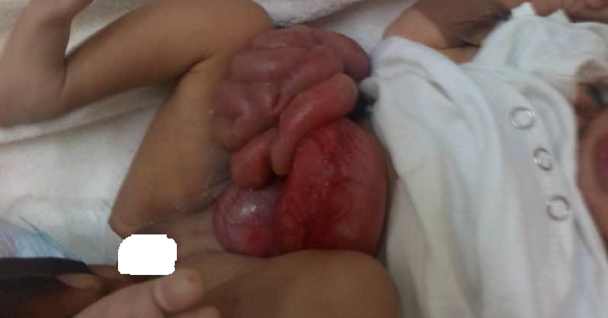 Sierra Leonean Parent Pleads For Funds to Operate Baby Who Was Born With Her Gut Out