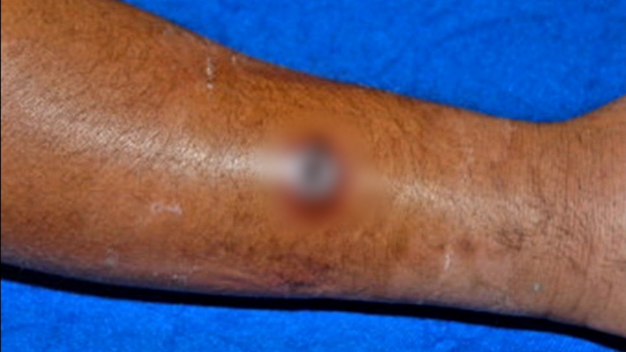 Health Authorities Confirm First Human Case of Anthrax Disease in Sierra Leone