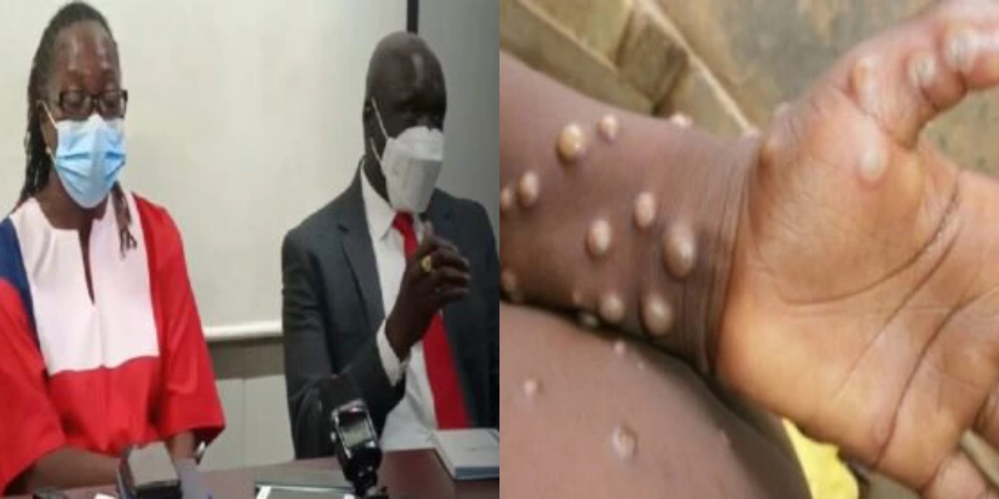 Worrying Signs For Sierra Leone as Neighbouring Liberia Confirms First Monkeypox Virus