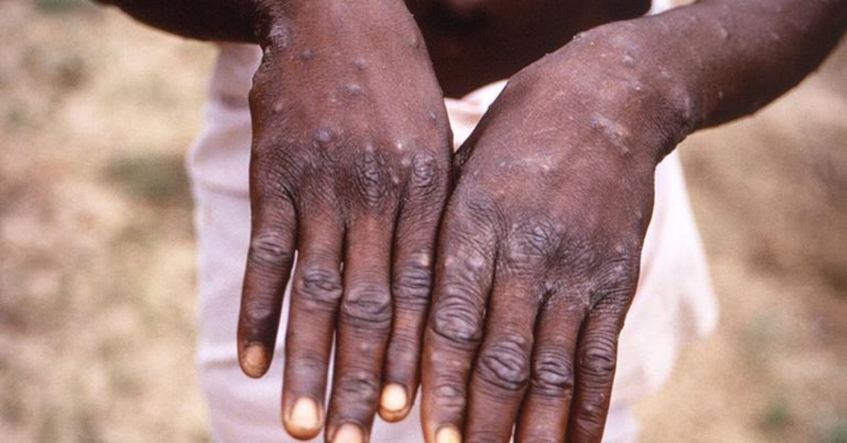 “In Africa, 63% Jump in Diseases Spread From Animals To People in Last Decade” – WHO