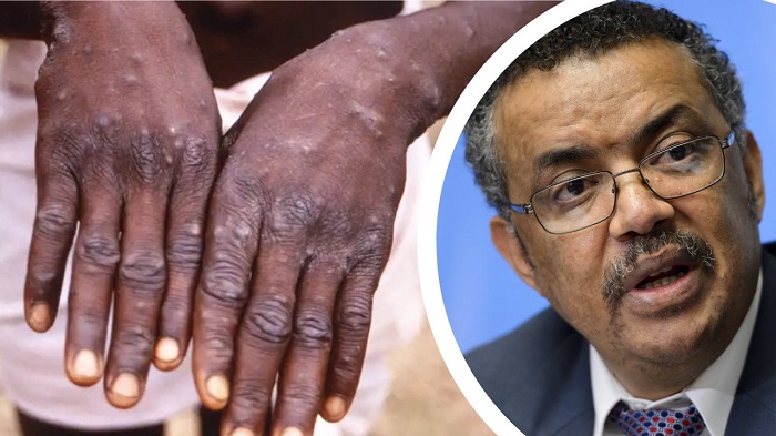 WHO Declares Monkeypox Outbreak Global Health Emergency