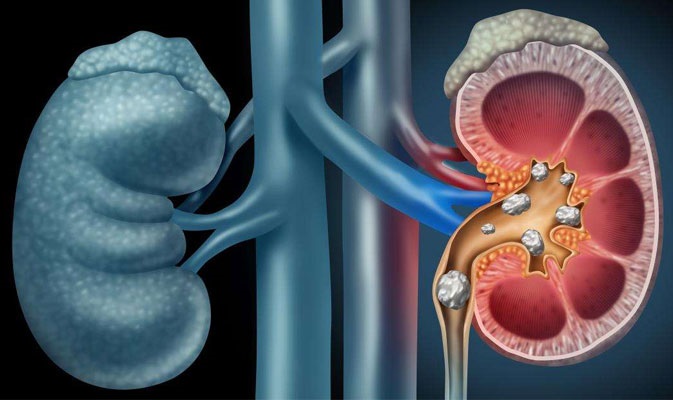 Foods That Are Capable of Causing Kidney Stones if Taken Regularly
