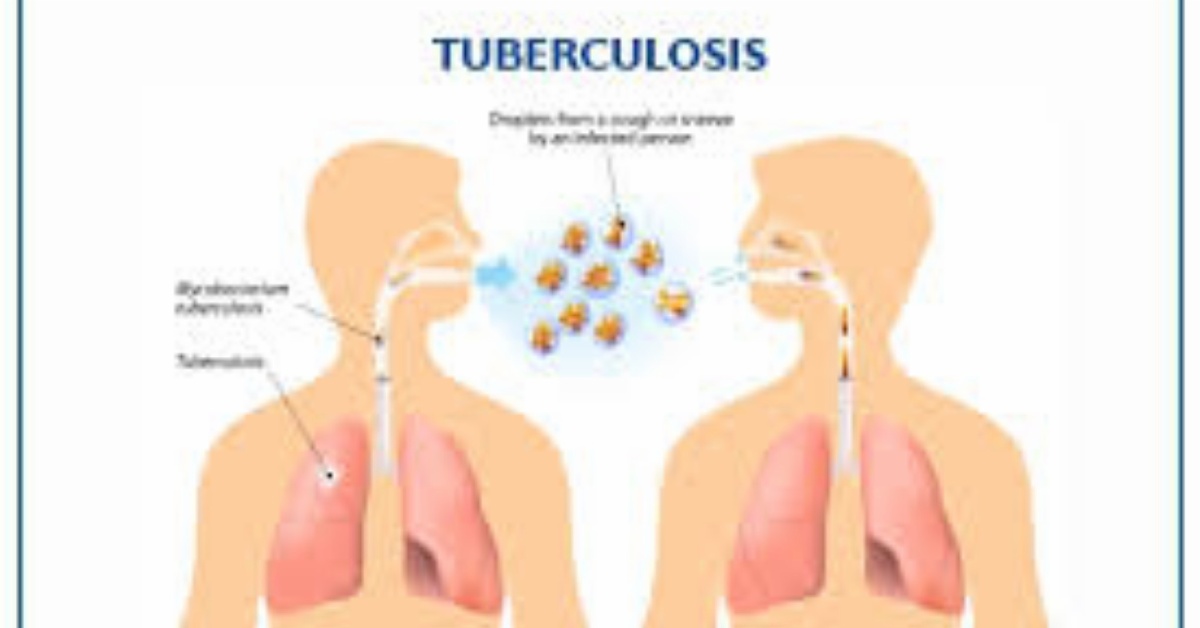 5,000 TB Patients Missing Yearly – CISMAT-SL