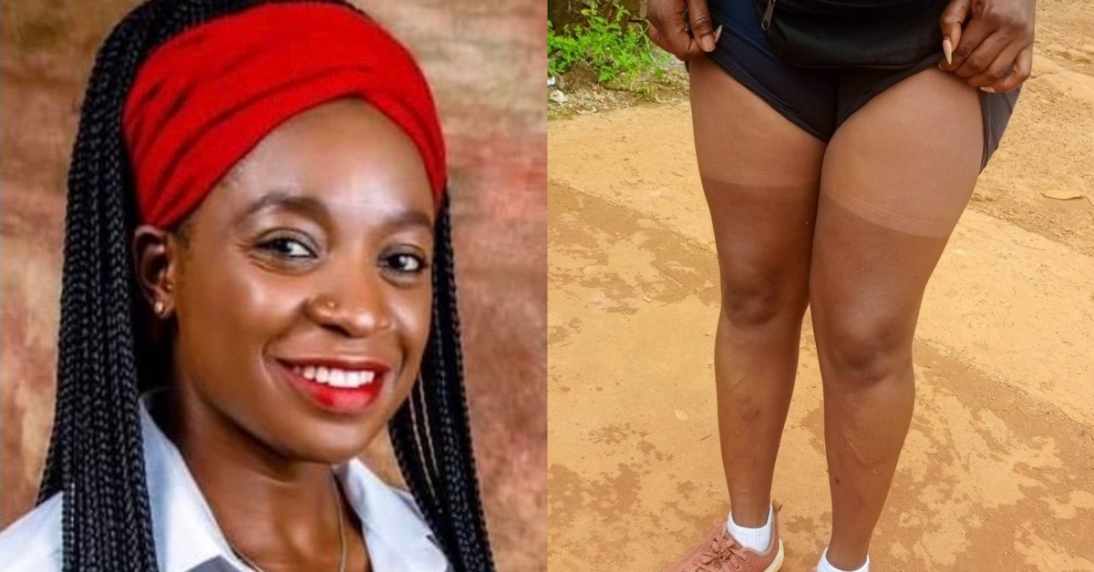 Phebean Swill Seeks Help For Mysterious Skin Transformation After Mambo Waterfall Visit