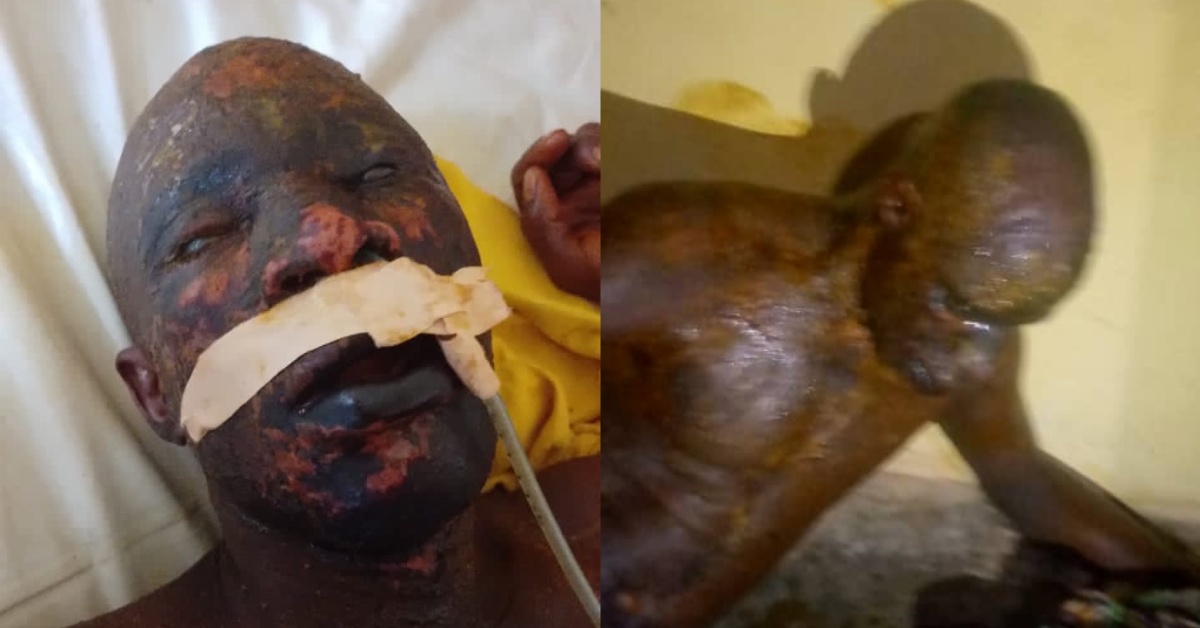 Farmer Injured in Caustic Soda Attack by Wife in Kenema