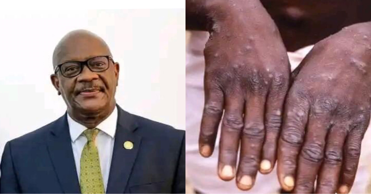 Government Provides Latest Update on Sierra Leone Mpox Cases