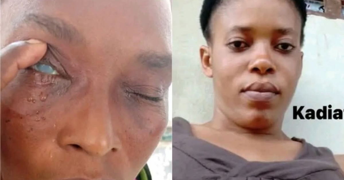 Woman Allegedly Attacks Sister-in-Law with Acid in Bo City