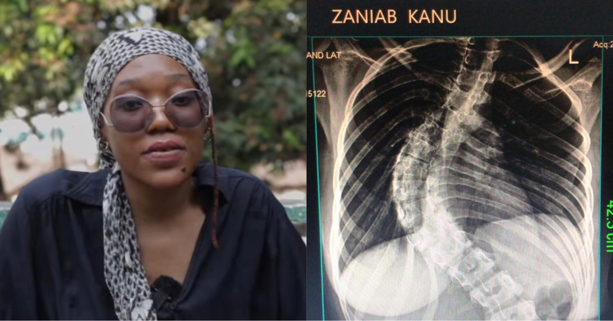 FBC Student With Life-Threatening Scoliosis Seek $50,000 For Surgery