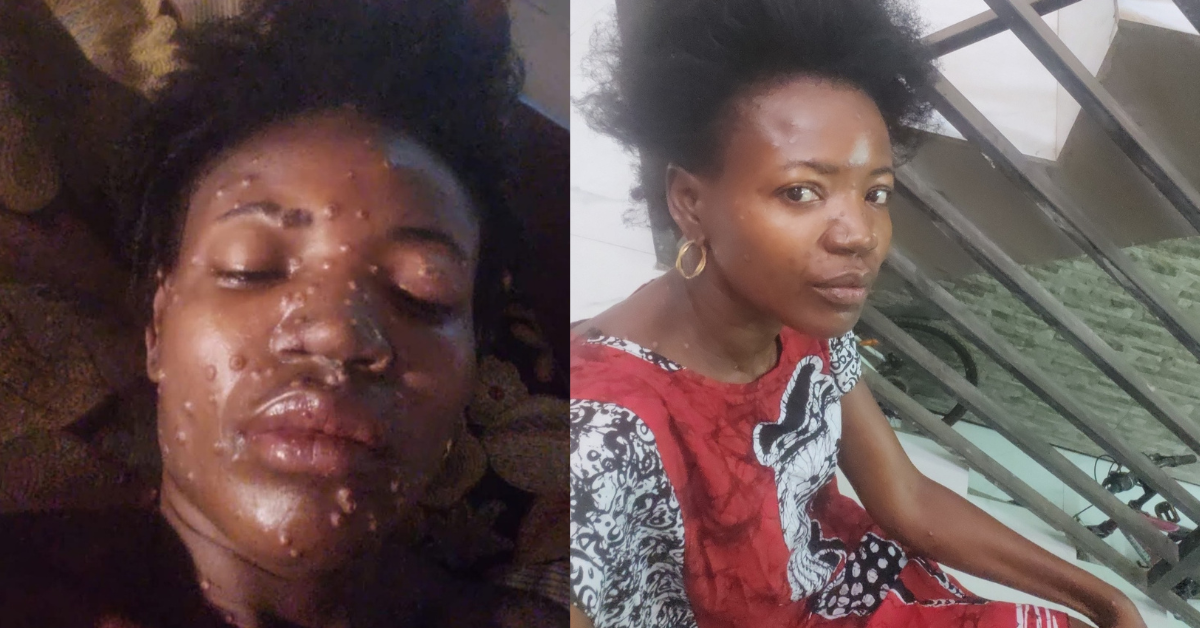 Hawa Hunt Provides Update on Recovery from Mpox Disease