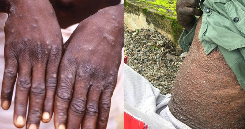 Government Issues Mpox Safety Regulations for Public Spaces and Institutions
