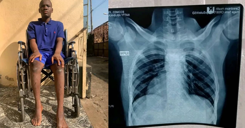 Life-Saving Surgery: 17-Year-Old Abu Bakar Appeals for Financial Assistance
