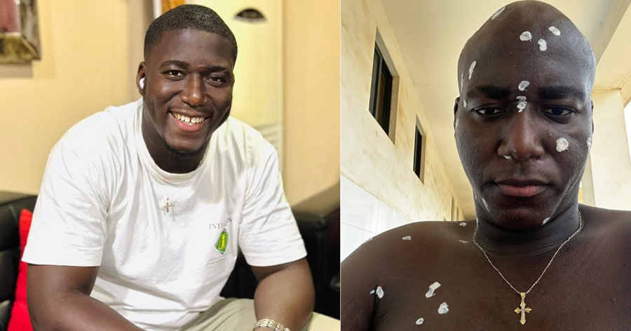 Social Media Influencer Akmed Sidi Dies of Mpox Amid Rising Cases