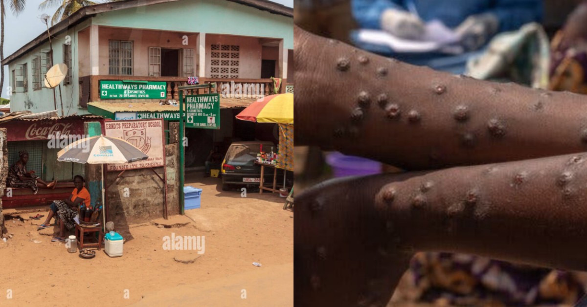 Kenema Bans Drug Stores from Treating Mpox Patients
