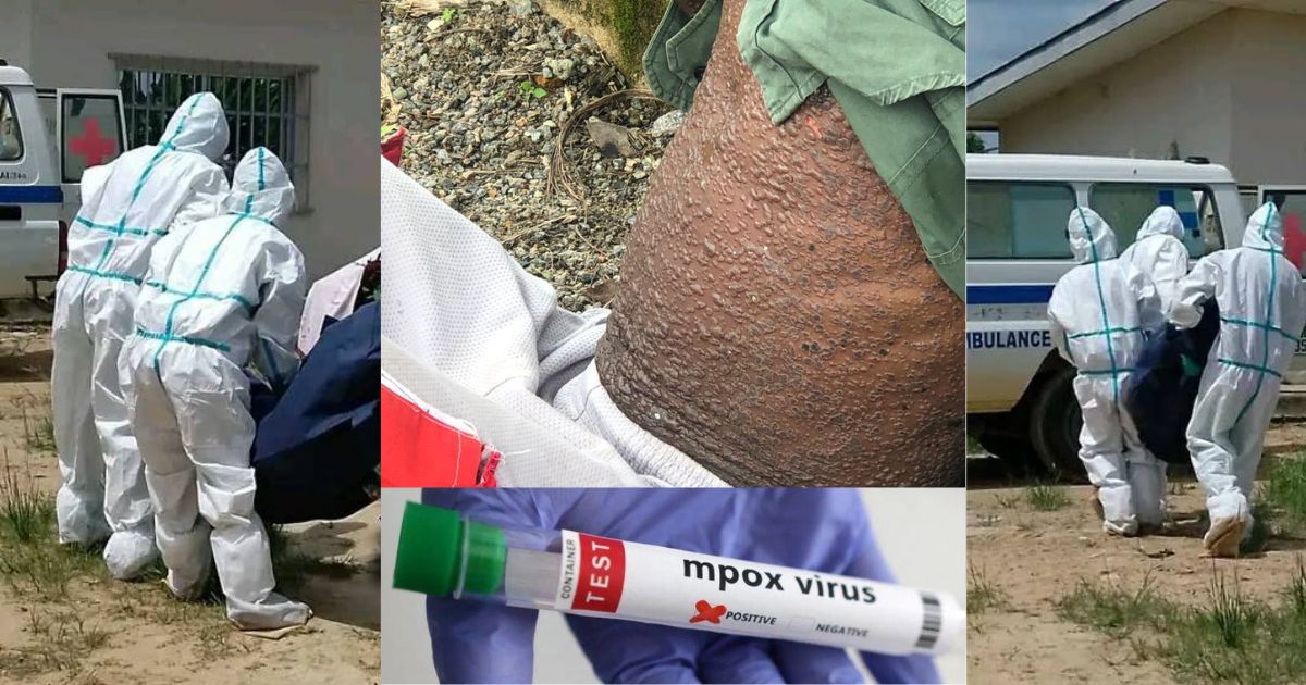 Mpox Disease Hits 39 Sierra Leoneans as Death Toll Rises to 30
