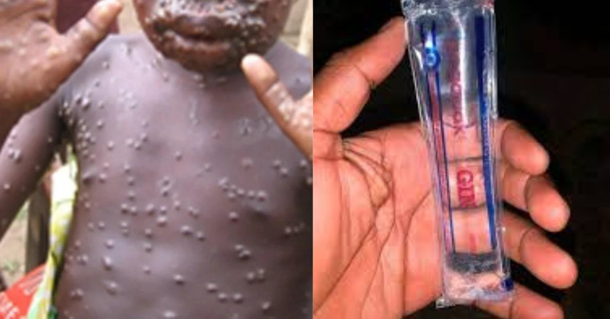 Ministry of Health Addresses Misinformation on Mpox Cure