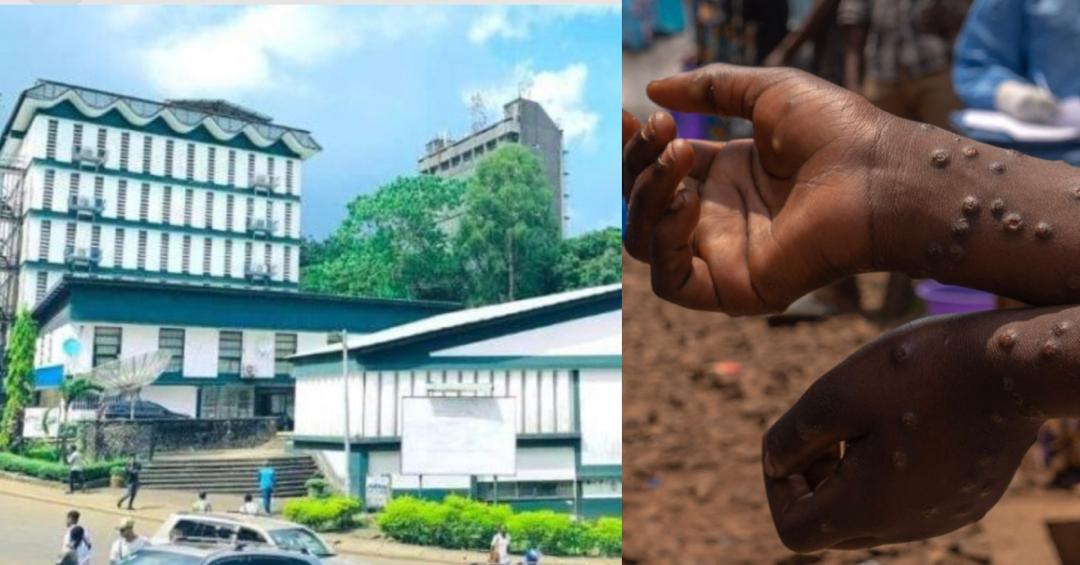 University of Sierra Leone Issues Health Advisory to Students Amid Rising Mpox Cases