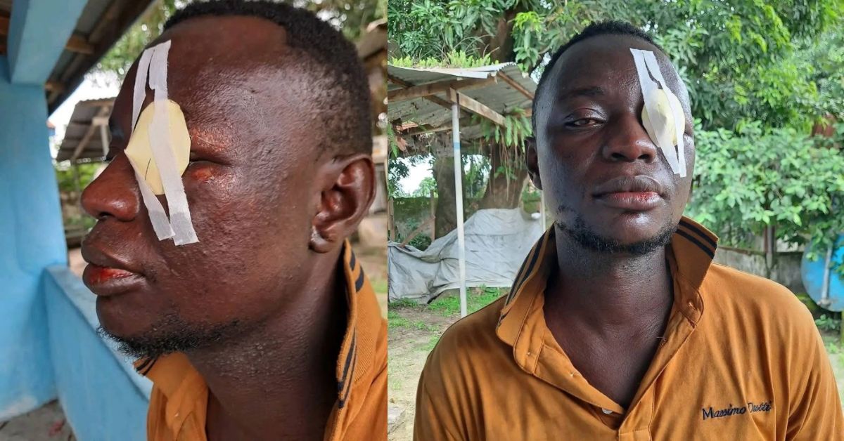 Angry Girlfriend Pours Acid on Boyfriend’s Eye in Koidu City