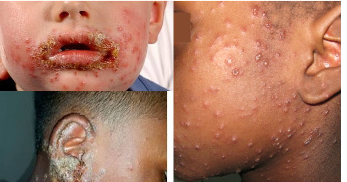 NPHA Launches Rapid Investigation Into Mysterious Skin Lesions Affecting Students in Bombali