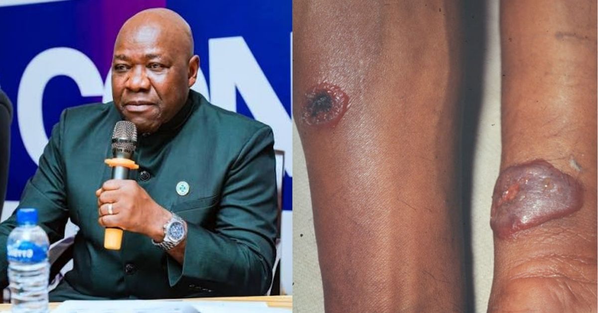 NPHA Dismisses Reports of Anthrax Disease Outbreak in Port Loko