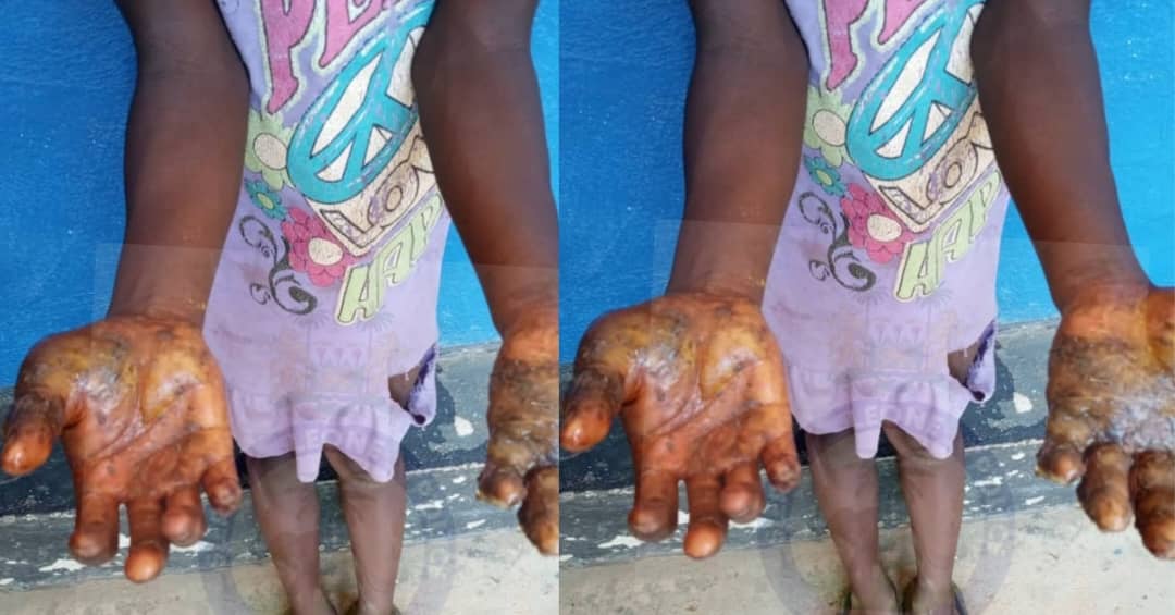 Police Formally Charge Woman for Allegedly Burning Seven-Year-Old Girl’s Hand