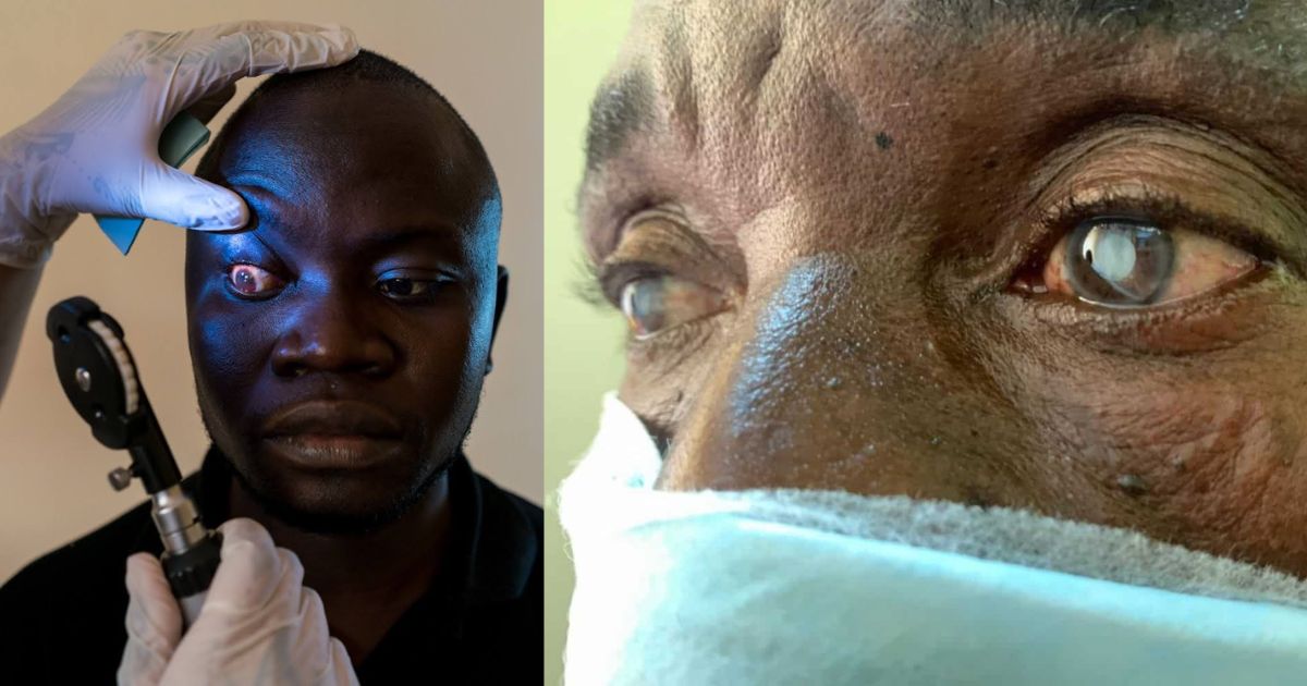 Ministry of Health and Choithram Hospital Launch Free Nationwide Cataract Surgery Program