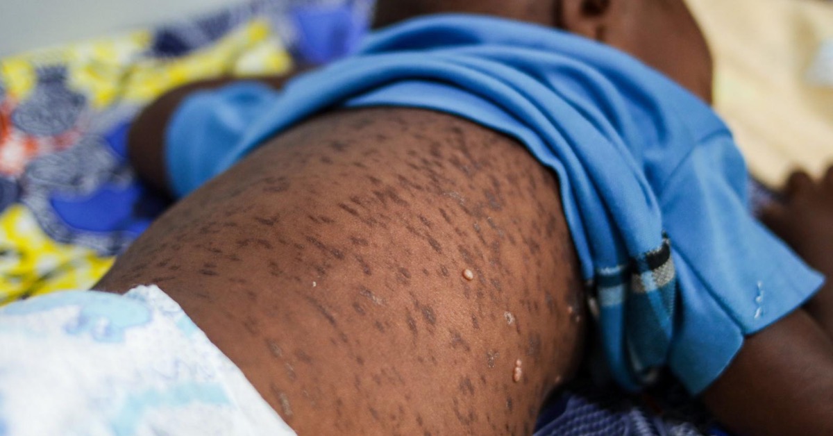 Government Confirms Measles Outbreak as 41 Cases Recorded Across Eight Districts