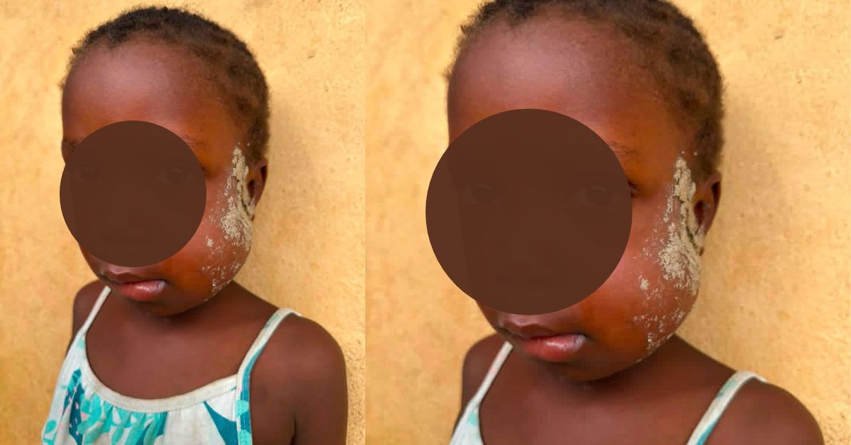 Family Appeals for Public Support as 4-Year-Old Battles Severe Jaw Condition