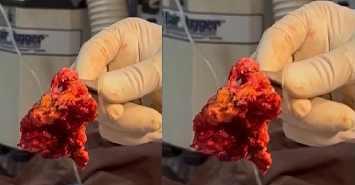 Connaught Hospital Surgeons Perform Sierra Leone’s First Brain Tumour Surgery